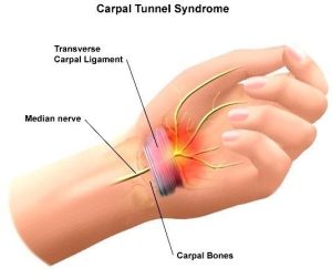 carpal-syndrome4