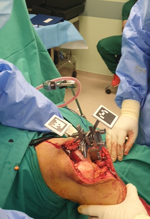 Τα οφέλη από την ρομποτική χειρουργική γόνατος